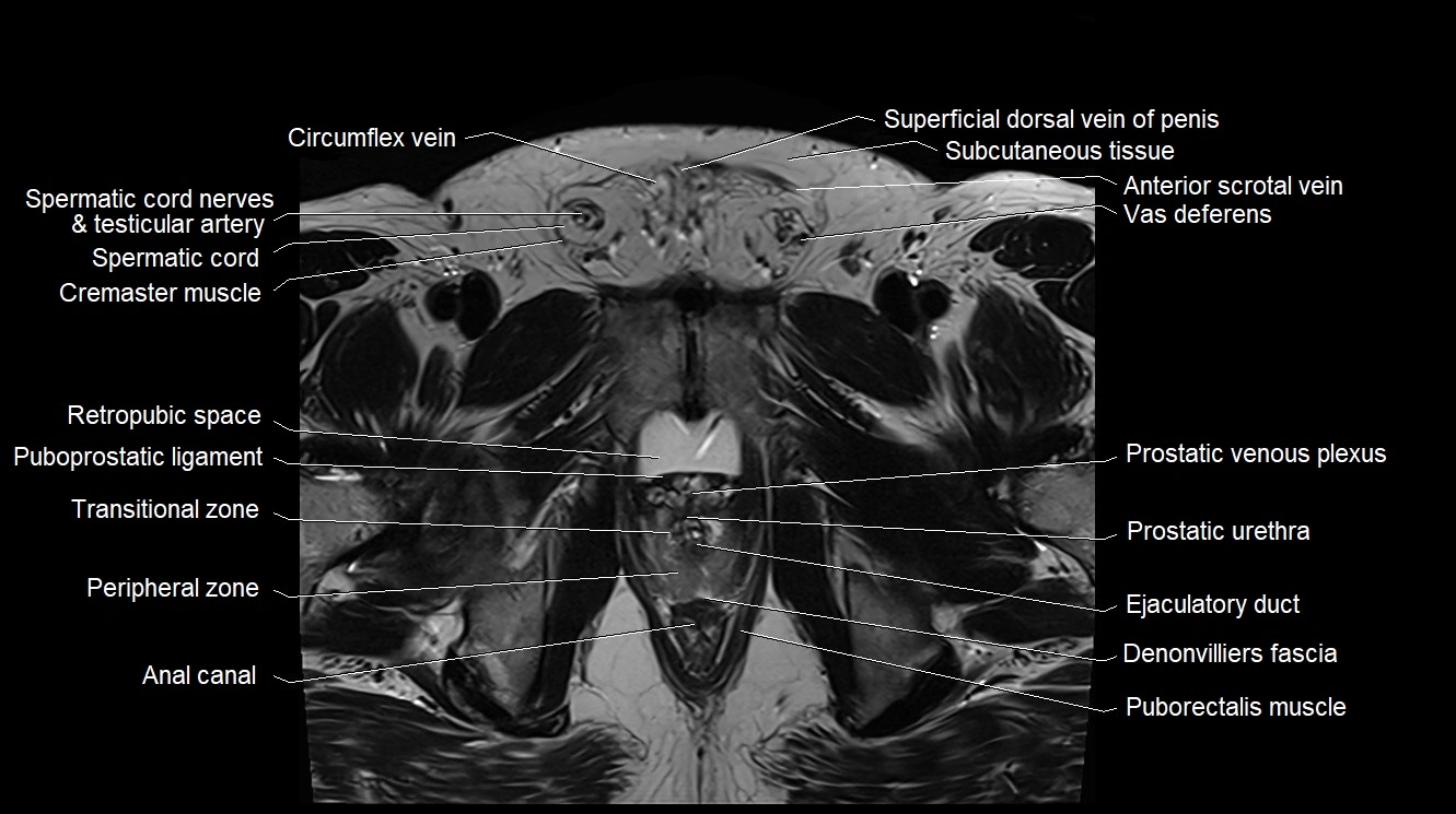 MRI 3T scrotum and penis axial cross sectional anatomy image 11.webp